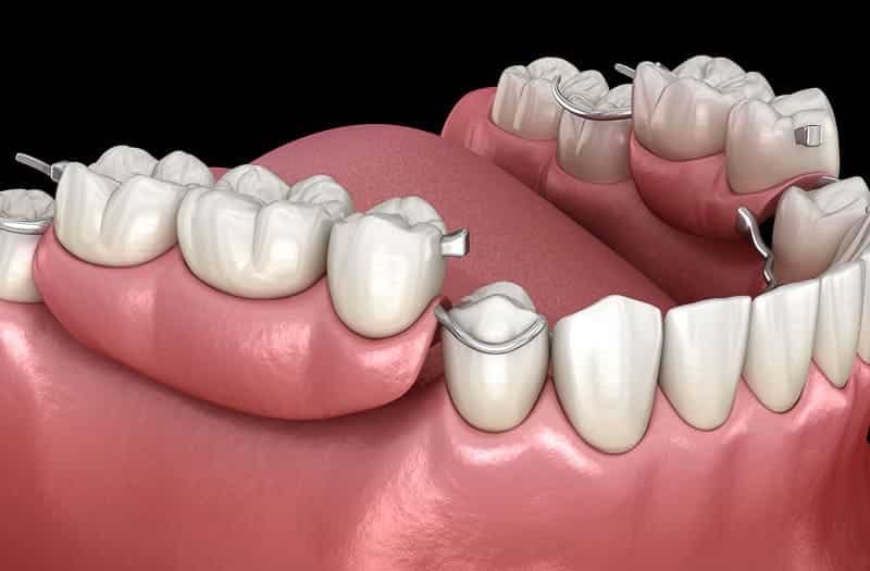 partial dentures