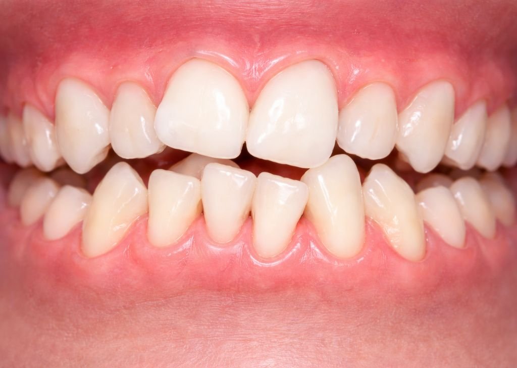 crowded teeth