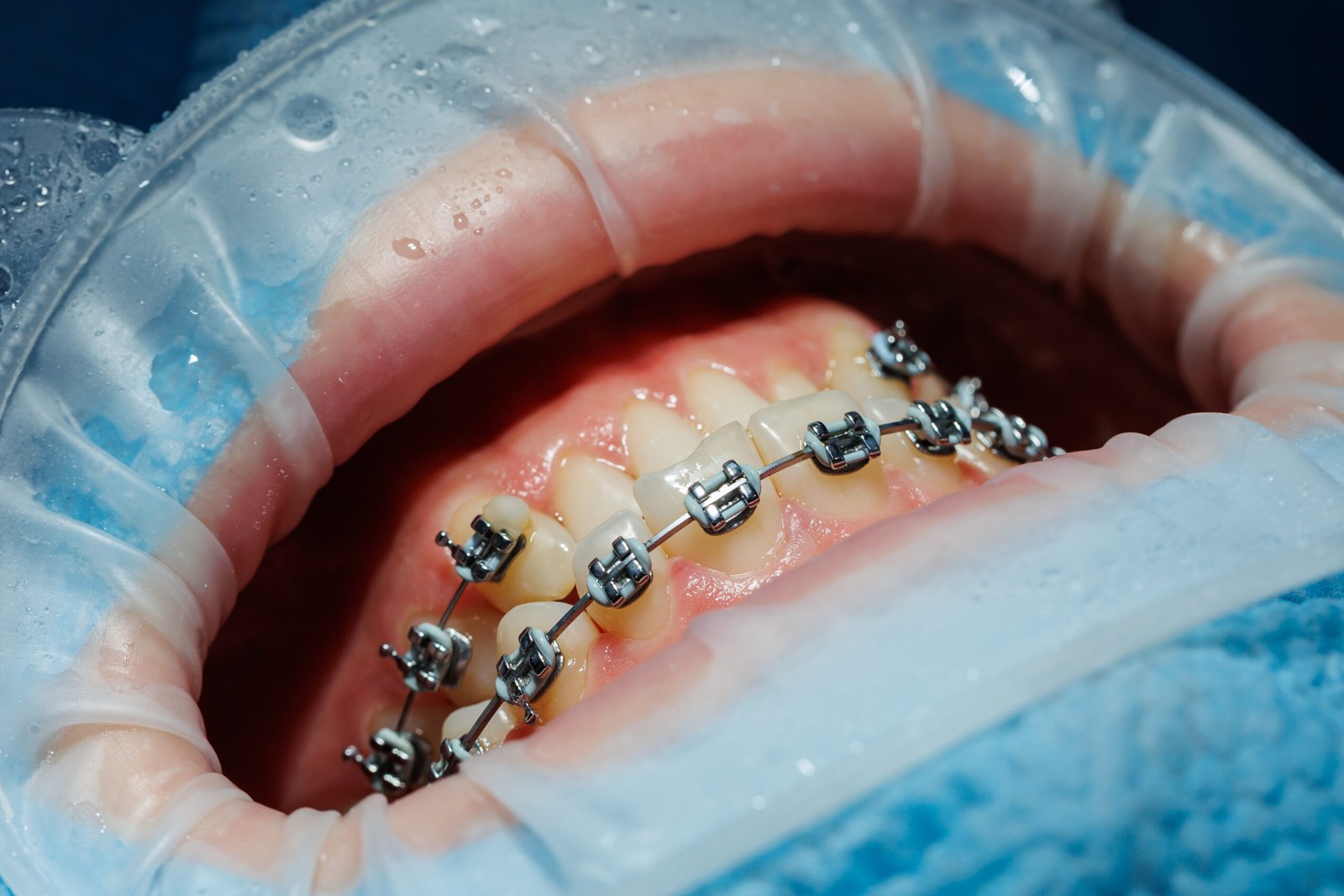 Braces treatment in Kuantan