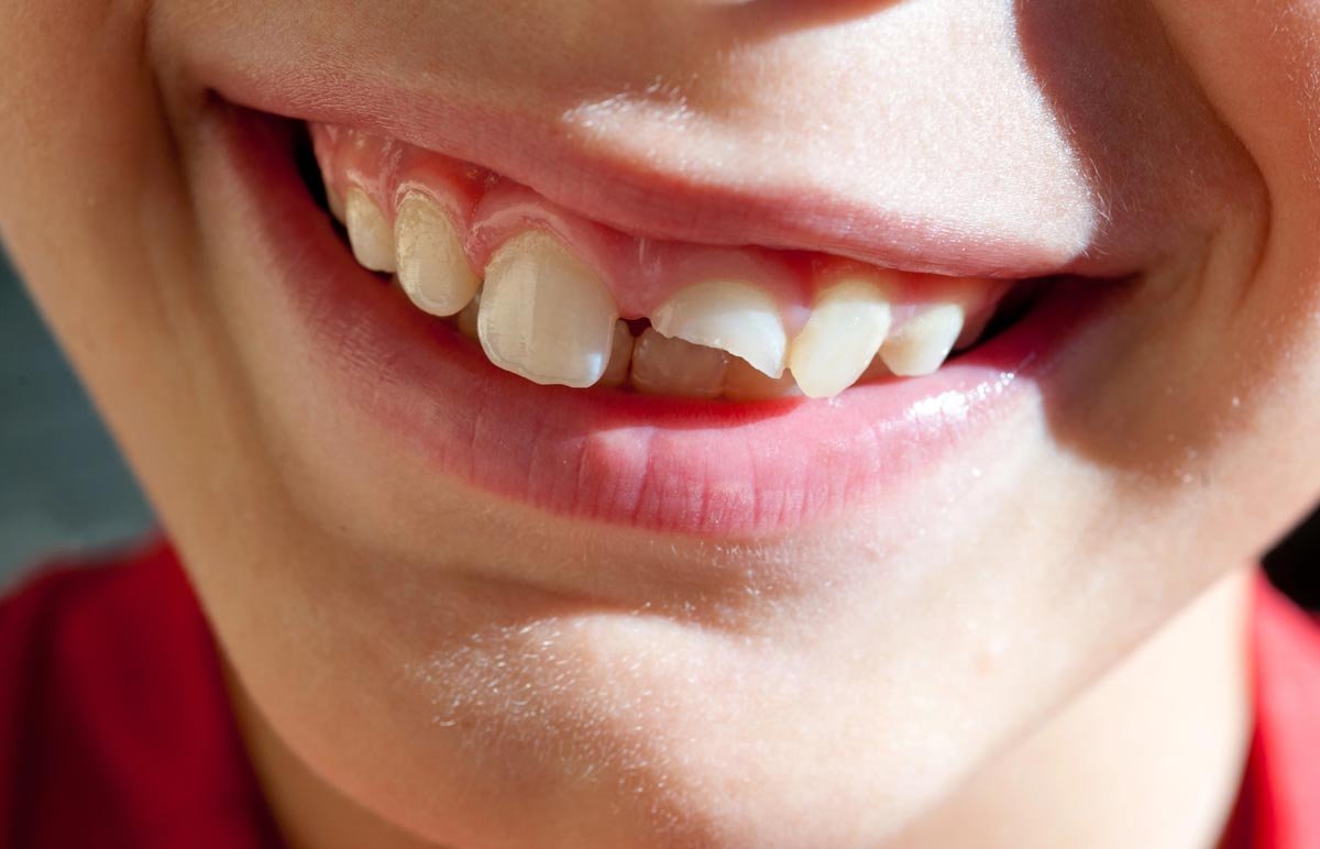 broken tooth