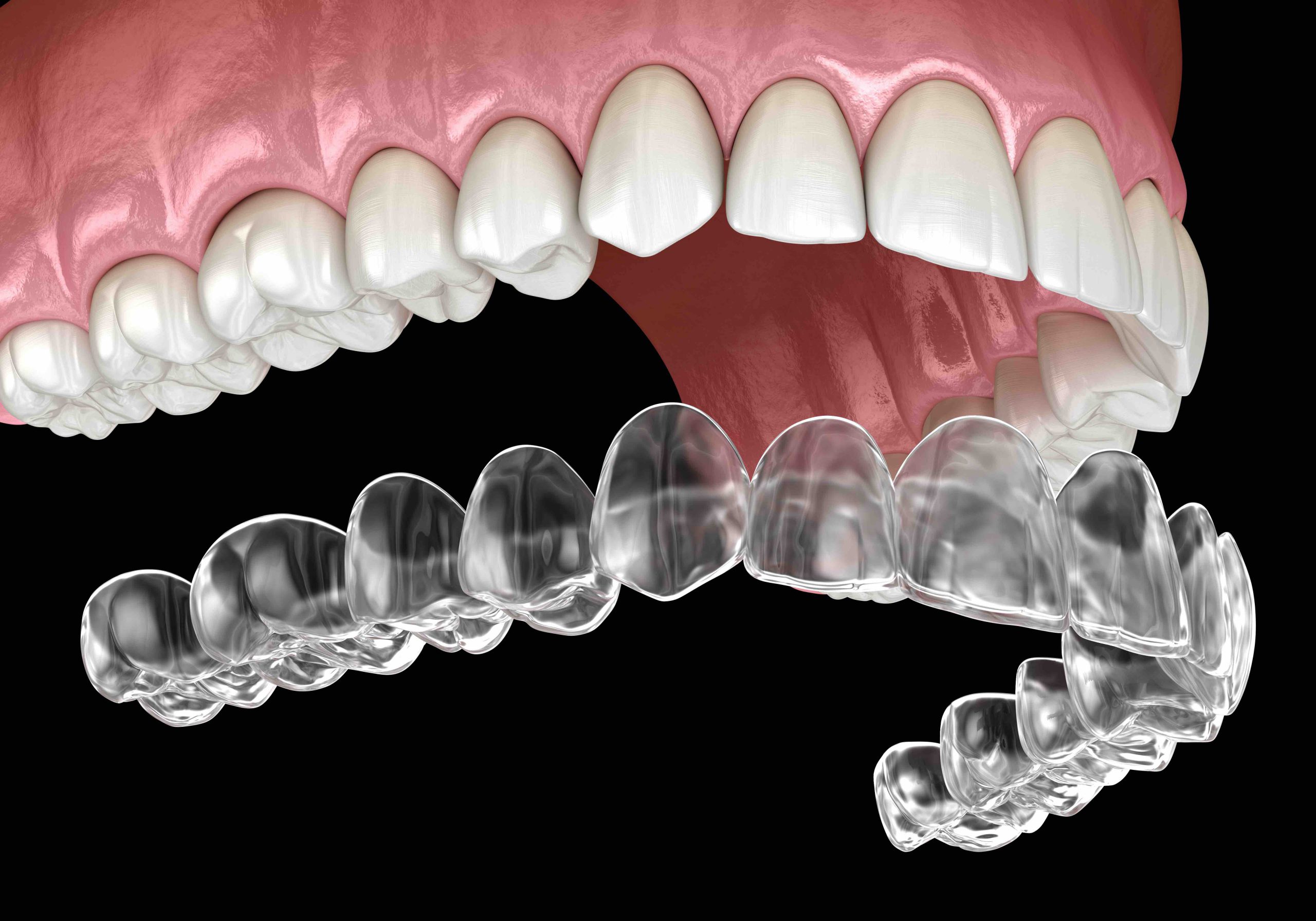 clear aligners