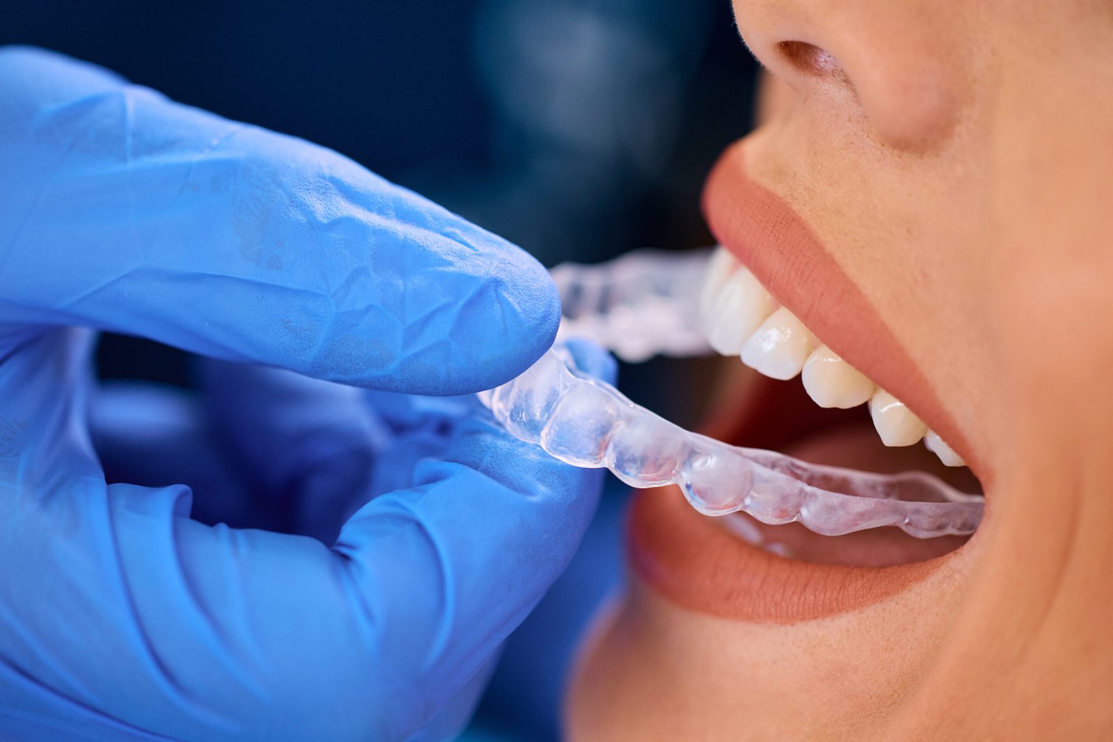 clear aligner