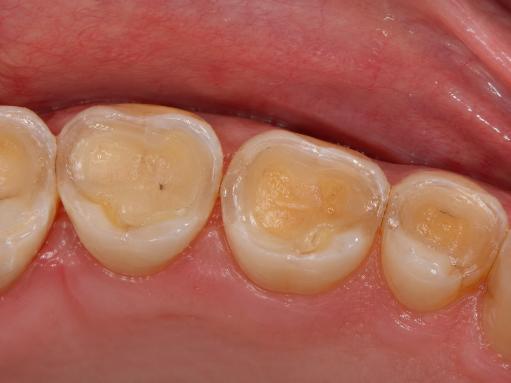 worn down teeth worn down teeth