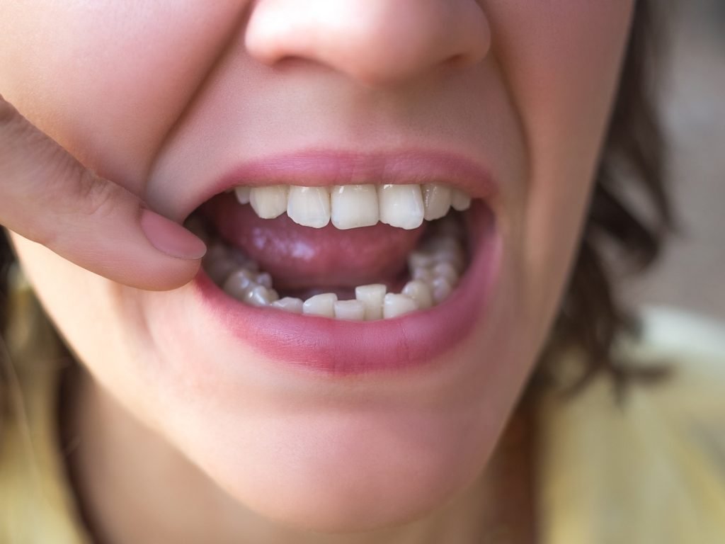 crowded teeth crowded teeth