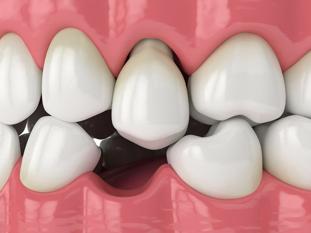 missing tooth on teeth missing teeth