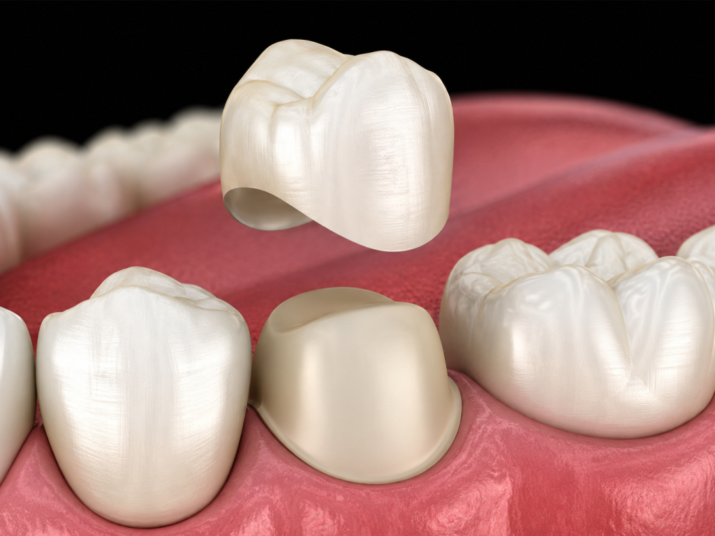 porcelain crowns porcelain crowns