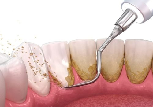 normal scaling teeth normal scaling teeth