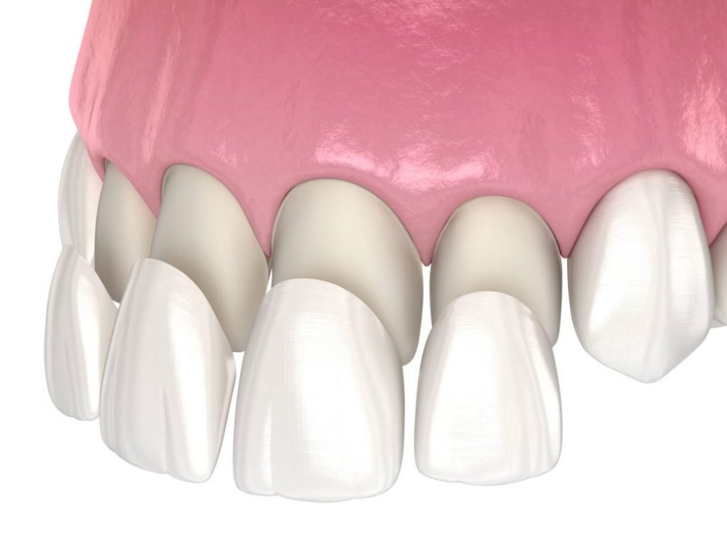 porcelain veneers