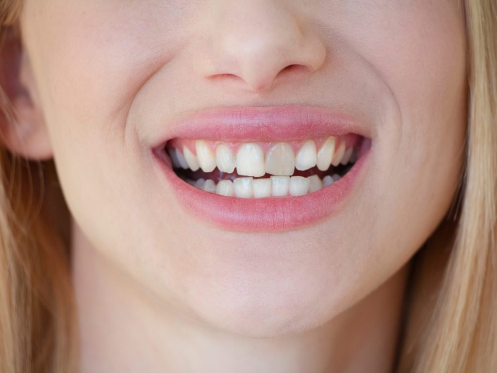 uneven tooth colour uneven tooth colour