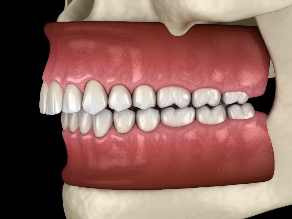 mild bite issues