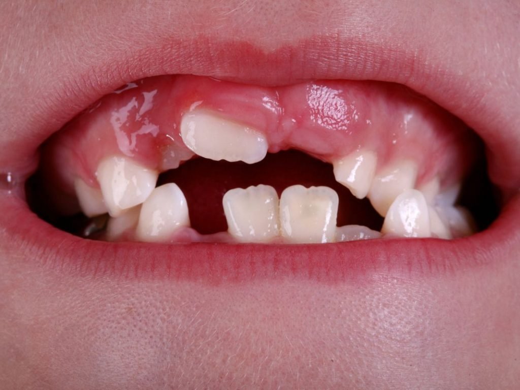 crooked teeth crooked teeth