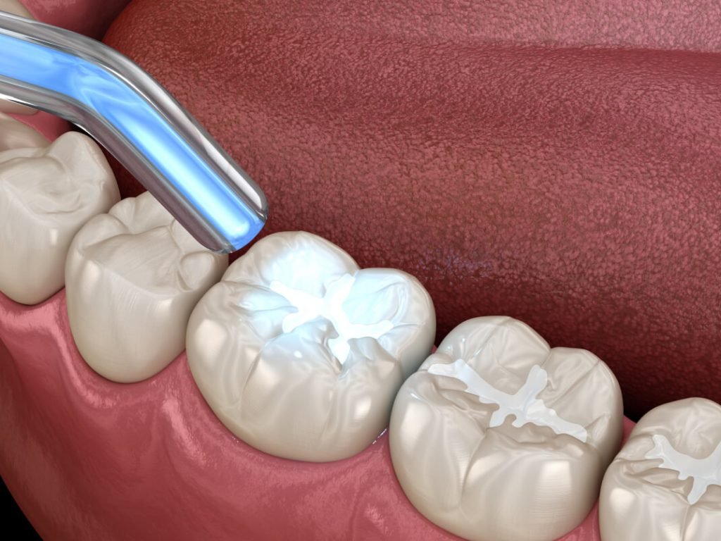 teeth fillings teeth fillings