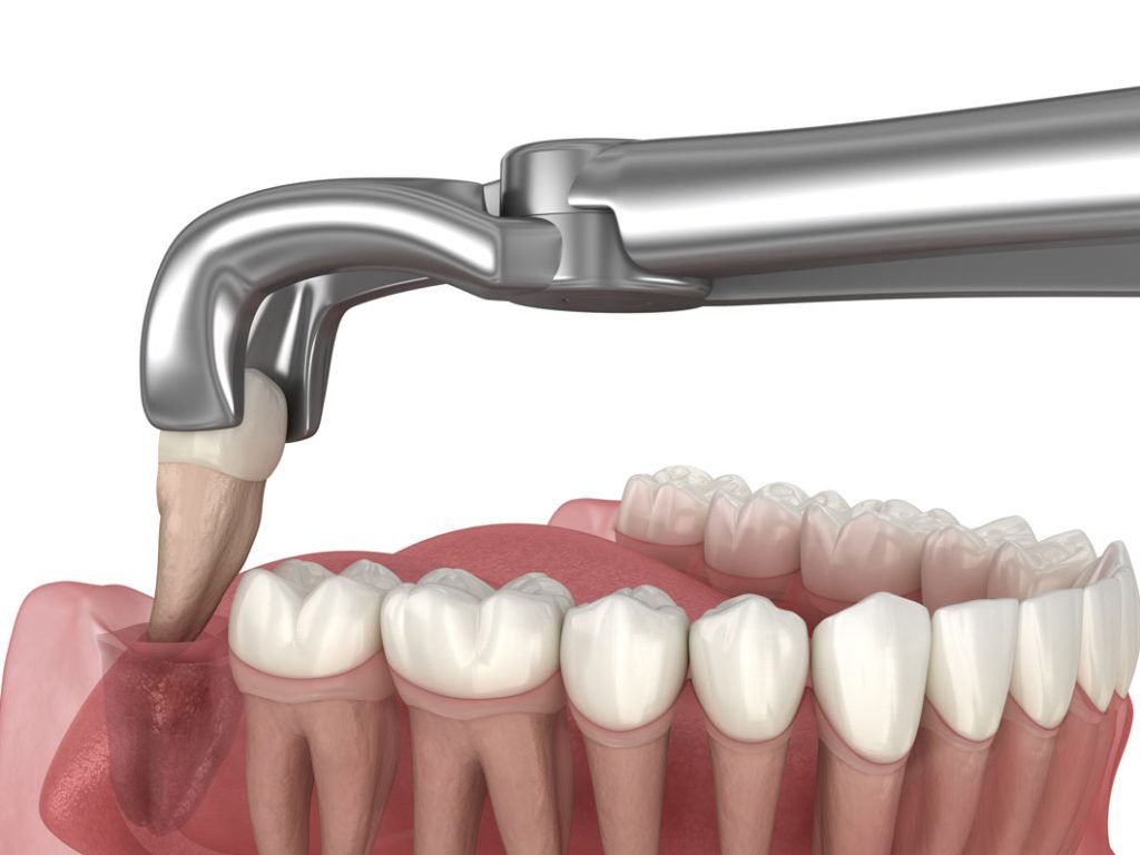 Wisdom-Tooth-Extraction