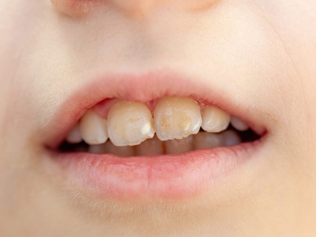 teeth discoloration