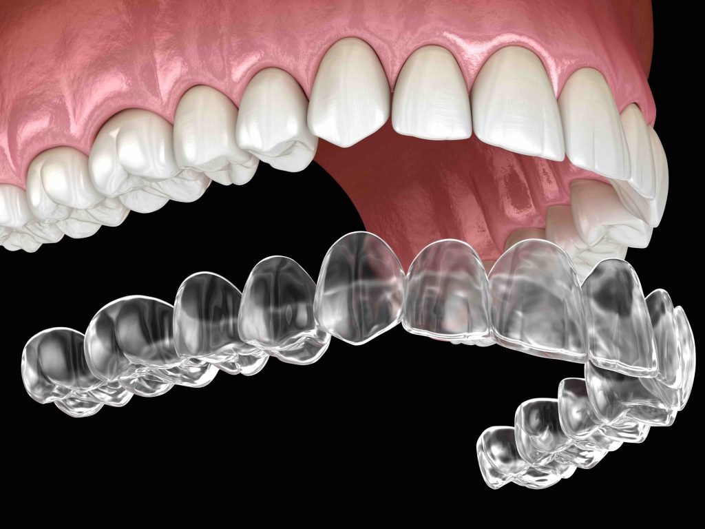 clear aligners