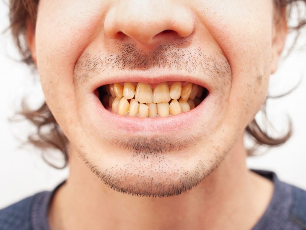 yellow teeth yellow teeth