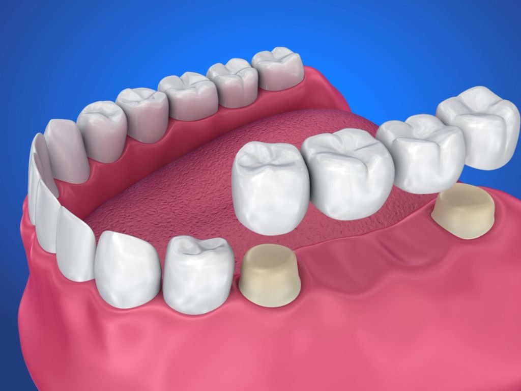 bridge teeth bridge teeth