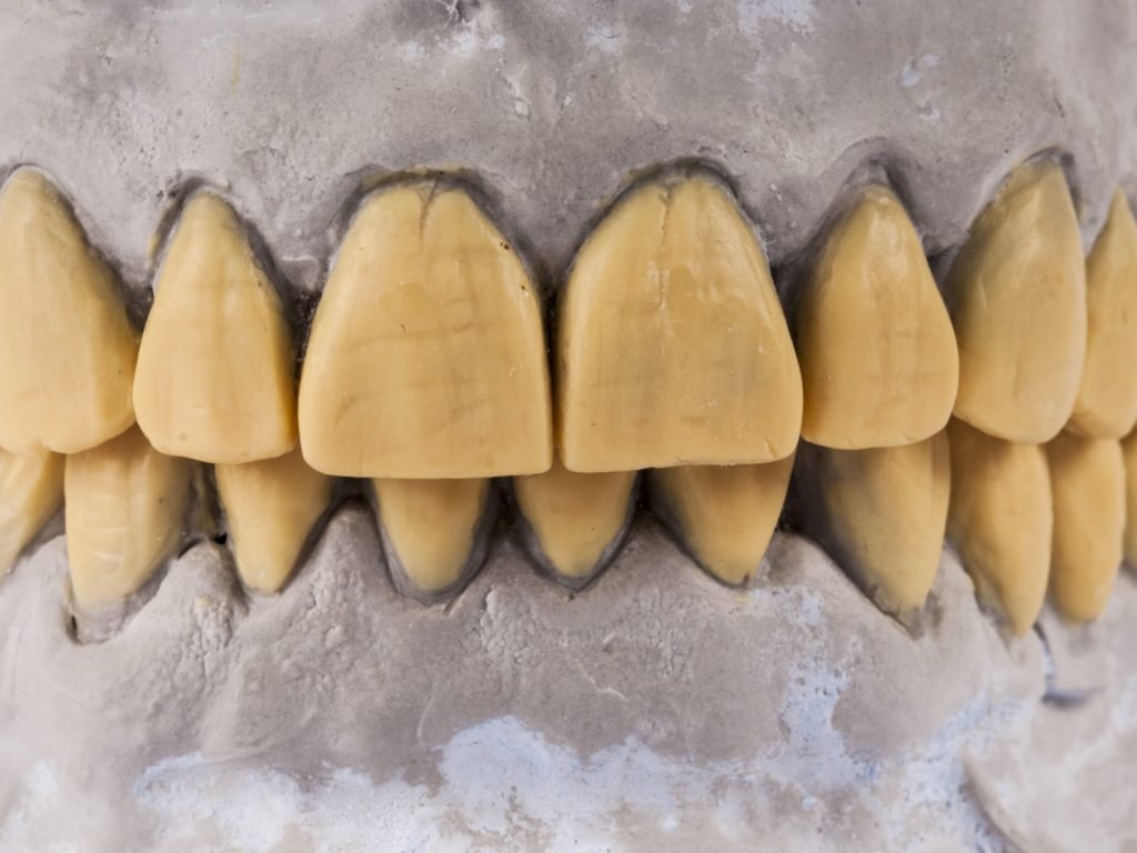 crowded teeth