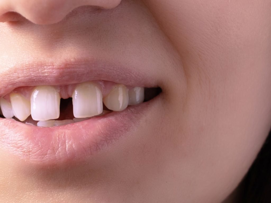 gaps between teeth gaps between teeth