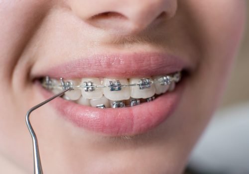 macro-shot-of-teeth-with-braces-female-patient-wi-2023-11-27-05-28-00-utc-rotated.jpg macro-shot-of-teeth-with-braces-female-patient-wi-2023-11-27-05-28-00-utc-rotated.jpg