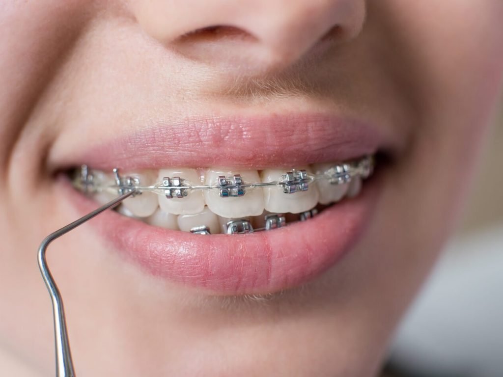 macro-shot-of-teeth-with-braces-female-patient-wi-2023-11-27-05-28-00-utc-rotated.jpg