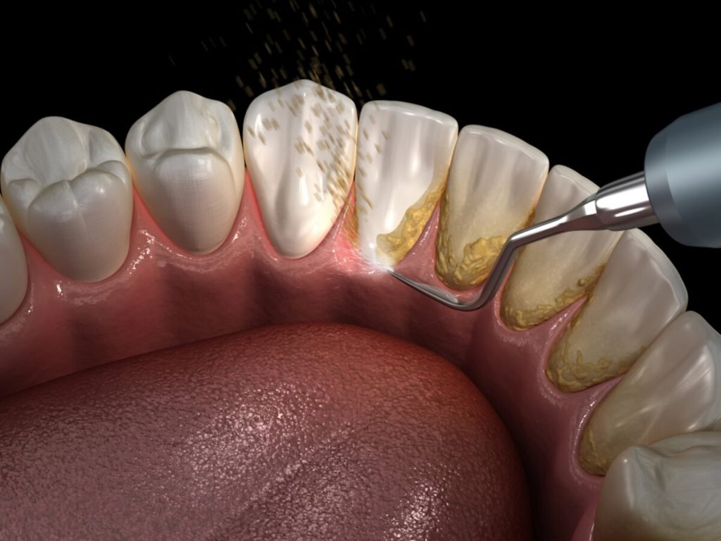 teeth cleaning